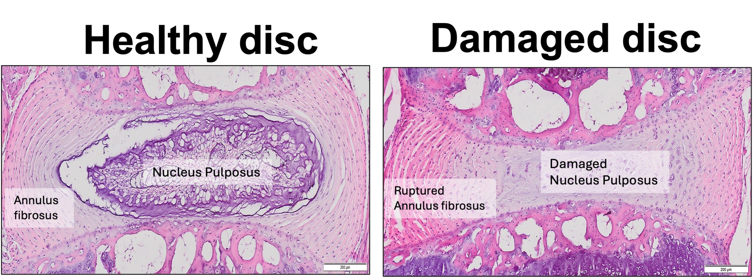 llustration showing a health disc and a damaged disc